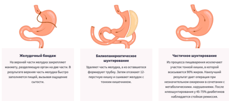 5 популярных методов бариатрической хирургии 1